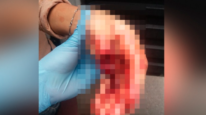 Ladrón muerde y le arranca parte del dedo a una mujer para robarle