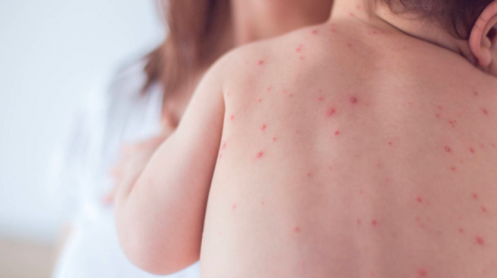 Familia antivacunas viaja a Costa Rica y propaga el sarampión