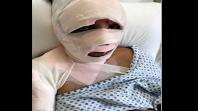 Joven sufre ataque con ácido en la CDMX 