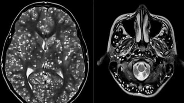 Con 18 años muere por tener el cerebro lleno de larvas