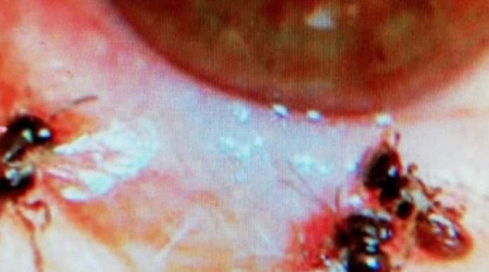 Encuentran abejas dentro del ojo de una mujer, se alimentaban de sus lágrimas