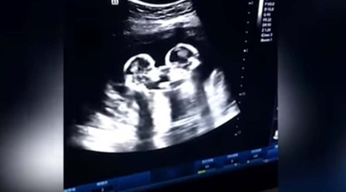 Video: Momento en que gemelas “pelean” en el vientre