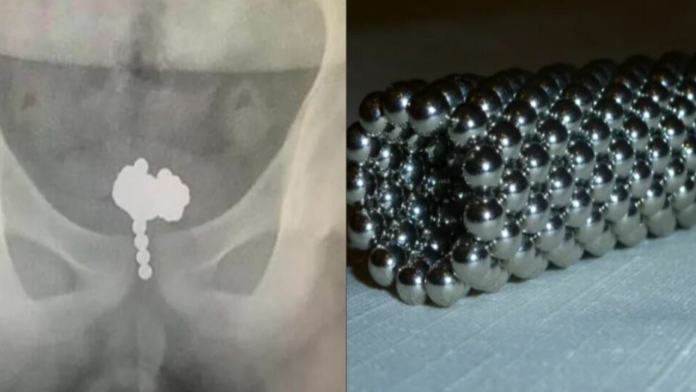 Niño es operado tras insertar en su pene 70 bolas magnéticas
