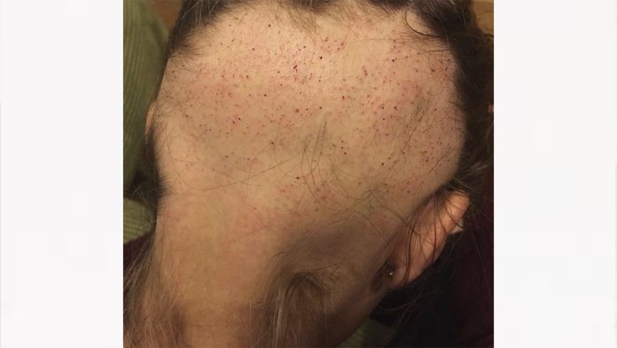 ¿Estás a punto de casarte? No te estreses, mujer pierde casi todo su cabello por el estrés de su boda