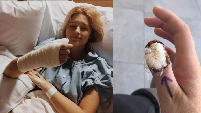 Por morderse las uñas mujer contrae cáncer y le amputan el dedo
