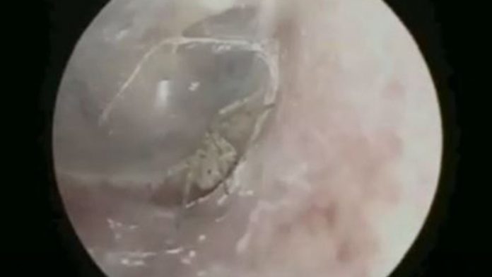 Encuentran araña tejiendo su telaraña en el oído de un hombre