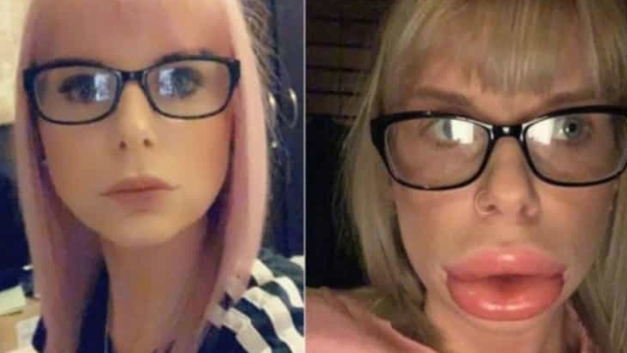 Tras inyectarse botox en los labios, joven queda desfigurada