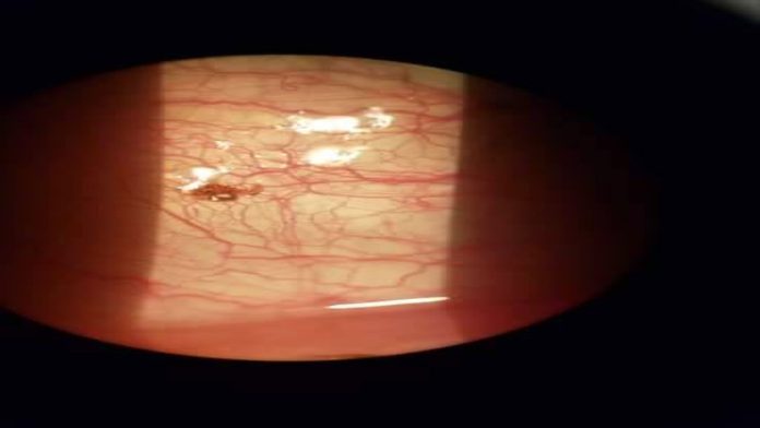 Fue al médico por irritación en el ojo; tenía una garrapata incrustada