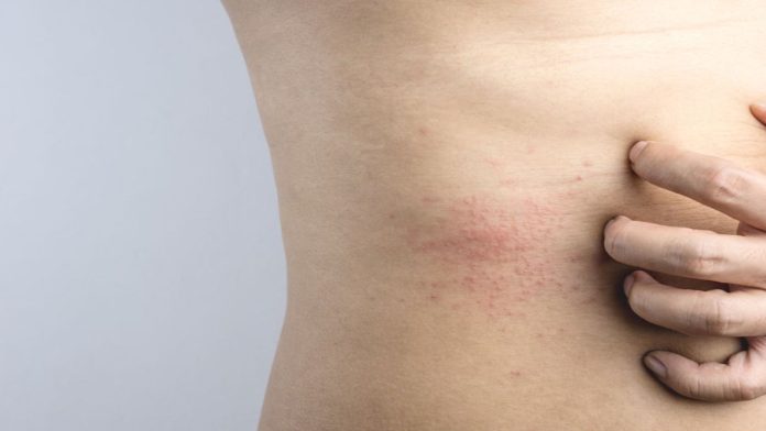 Culebrilla: enfermedad que se activa por estrés