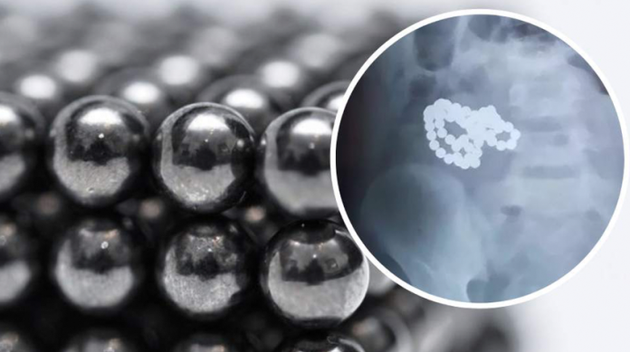 Extraen 61 bolas magnéticas del intestino de niño de 6 años