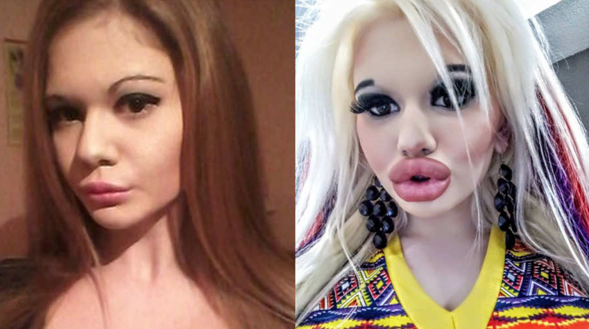 Joven de 22 años quiere los labios más grandes del mundo; lleva 15 operaciones Joven de 22 años quiere los labios más grandes del mundo; lleva 15 operaciones