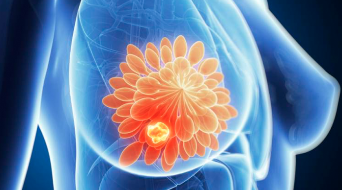 Crean vacuna contra el cáncer de mama; curaron a una mujer