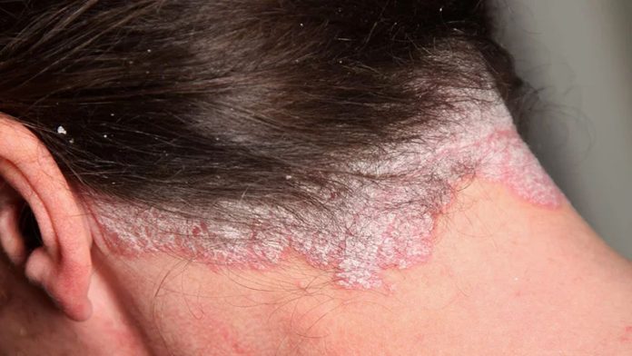 Psoriasis: enfermedad que afecta a 2.5 millones de mexicanos