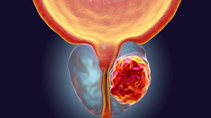 Mortandad por cáncer de próstata aqueja a los mexicanos