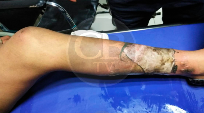 Explota pirotecnia en la bolsa del pantalón de niño de 12 años