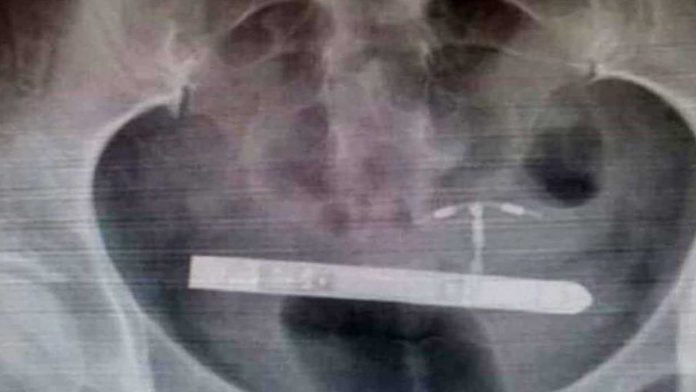 Mujer demandará a marca de juguetes sexuales; un vibrador encendido se quedó atrapado en su vejiga