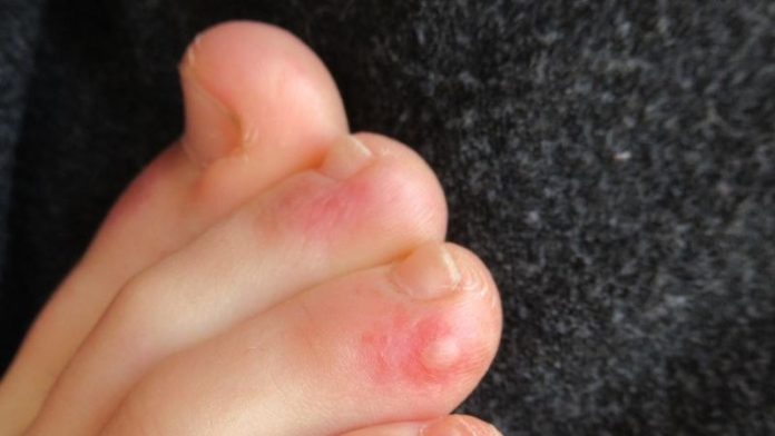 Investigan lesiones en los pies como posible síntoma en pacientes con Coronavirus