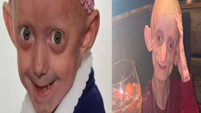 Muere joven con la enfermedad de “Benjamin Button”