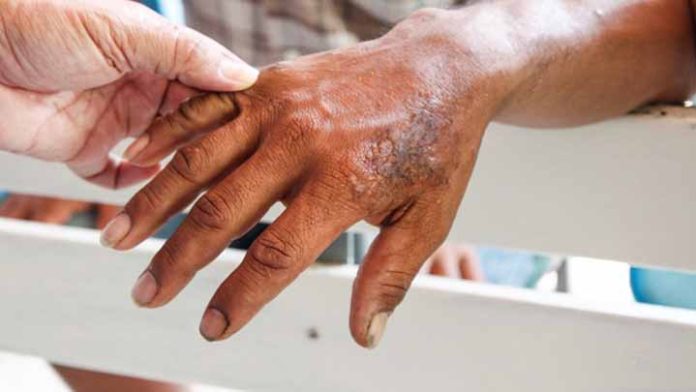 Diagnóstico y tratamiento temprano puede evitar secuelas en pacientes con Lepra