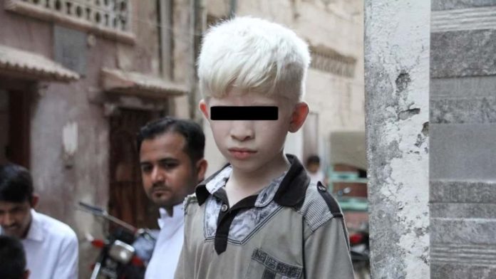 albino