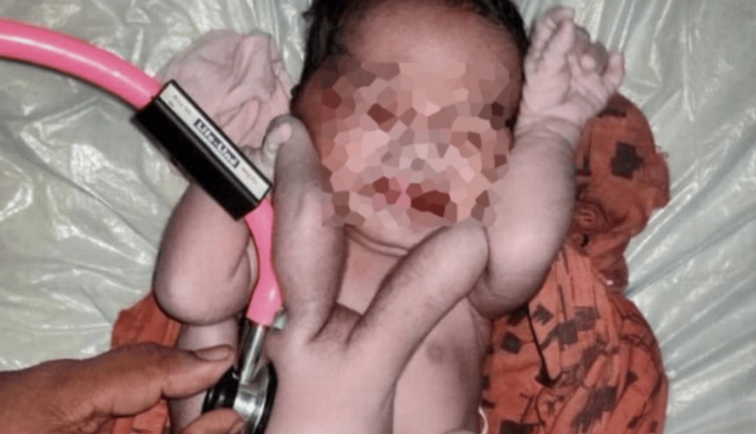 Nace bebé con cuatro brazos y cuatro piernas, “es un milagro de la naturaleza”