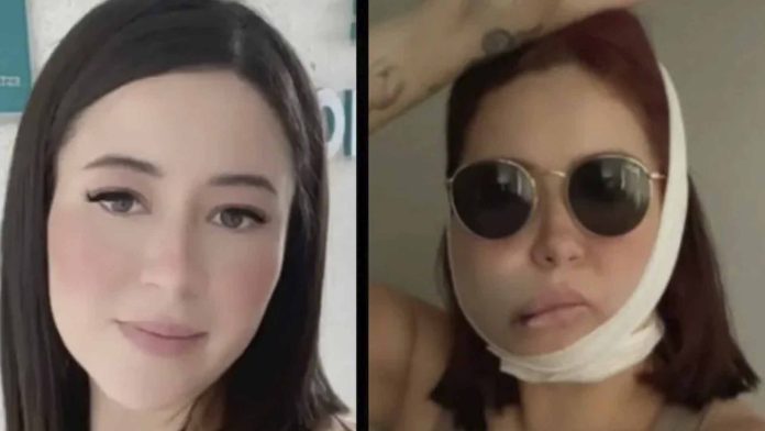 Mujer se hace bichectomía y su cara termina deformada