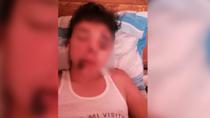 Por negligencia, pequeño de 14 años podría perder la vista luego de ser atropellado en Pátzcuaro