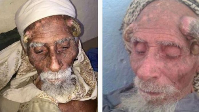Muere el hombre más viejo del mundo tras extirparle dos cuernos de la cabeza
