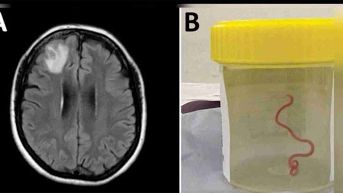 Hallan gusano vivo en el cerebro de una mujer