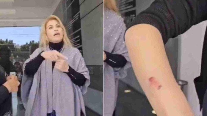 Mujer se niega a pagar servicio de uñas y muerde a manicurista