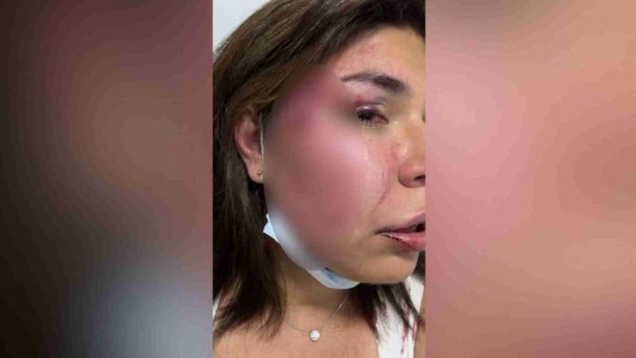 *Fotógrafa mexicana es víctima de intento de feminicidio en Colombia* La mexicana Valeria Hekker denunció por medio de redes sociales que fue víctima de una feminicidio por parte de un estadounidense en Colombia, solicitando a su vez ayuda de la Secretaria de Relaciones Exteriores. La publicación que realizó en redes fue acompañada por una fotografía donde se le puede observar un golpe en el rostro. Tras los hechos recibió ayuda y fue enviada a México dónde fue resguardarda, así lo informó Alicia Bárcena, secretaria de Relaciones Exteriores. Fuente: 24 horas