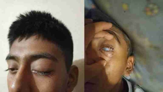 Estudiante de telesecundaria registra lesiones en ojo por bullying