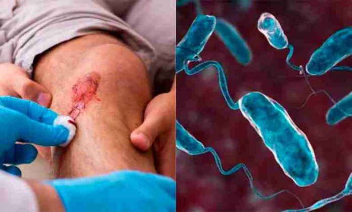 Bacteria carnívora causa alerta en Japón; mata en 2 día