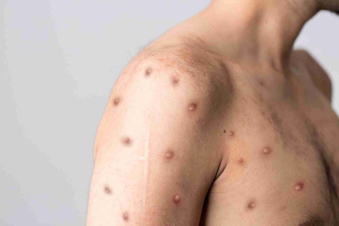 España, el país de Europa con más casos de viruela del Mono