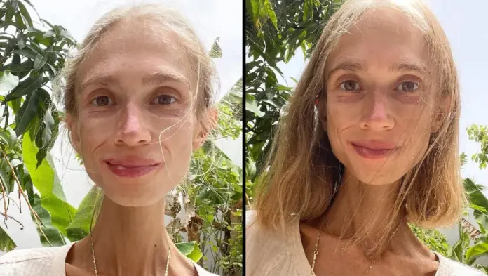 Mujer vegana fallece de desnutrición en Bali